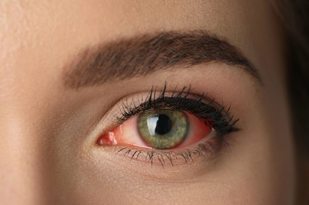 A close-up image of a woman's eye, appearing to have conjunctivitis.