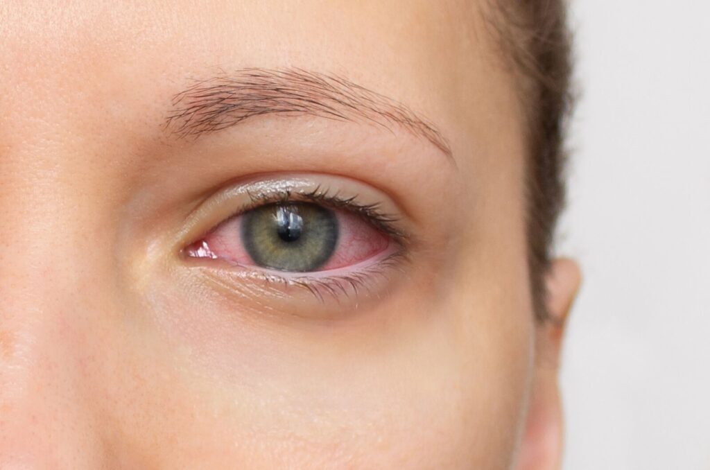 Close-up of a person's red eye, a symptom of dry eye syndrome.