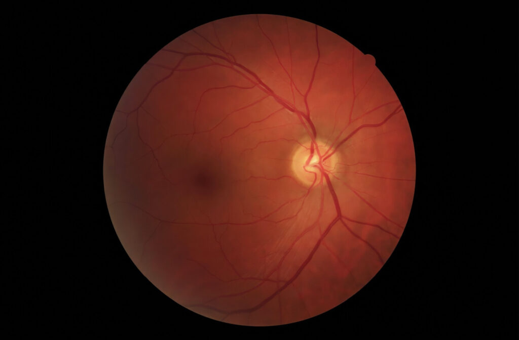 Retinal photograph showing the optic nerve and blood vessels inside the human eye.