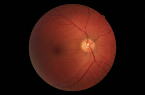 Retinal photograph showing the optic nerve and blood vessels inside the human eye.